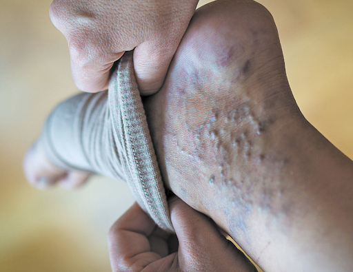 Varicose Veins Ablation Procedure