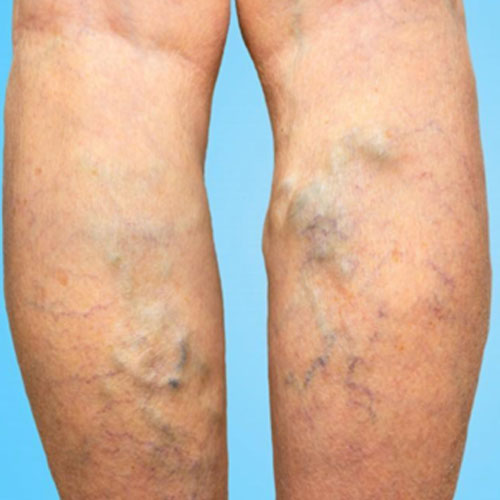 Non-Surgical Varicose Veins Treatment Results