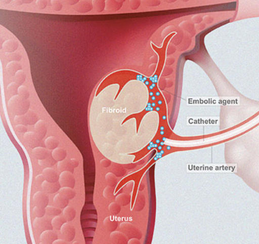 Uterine Fibroid Embolization clinical case
